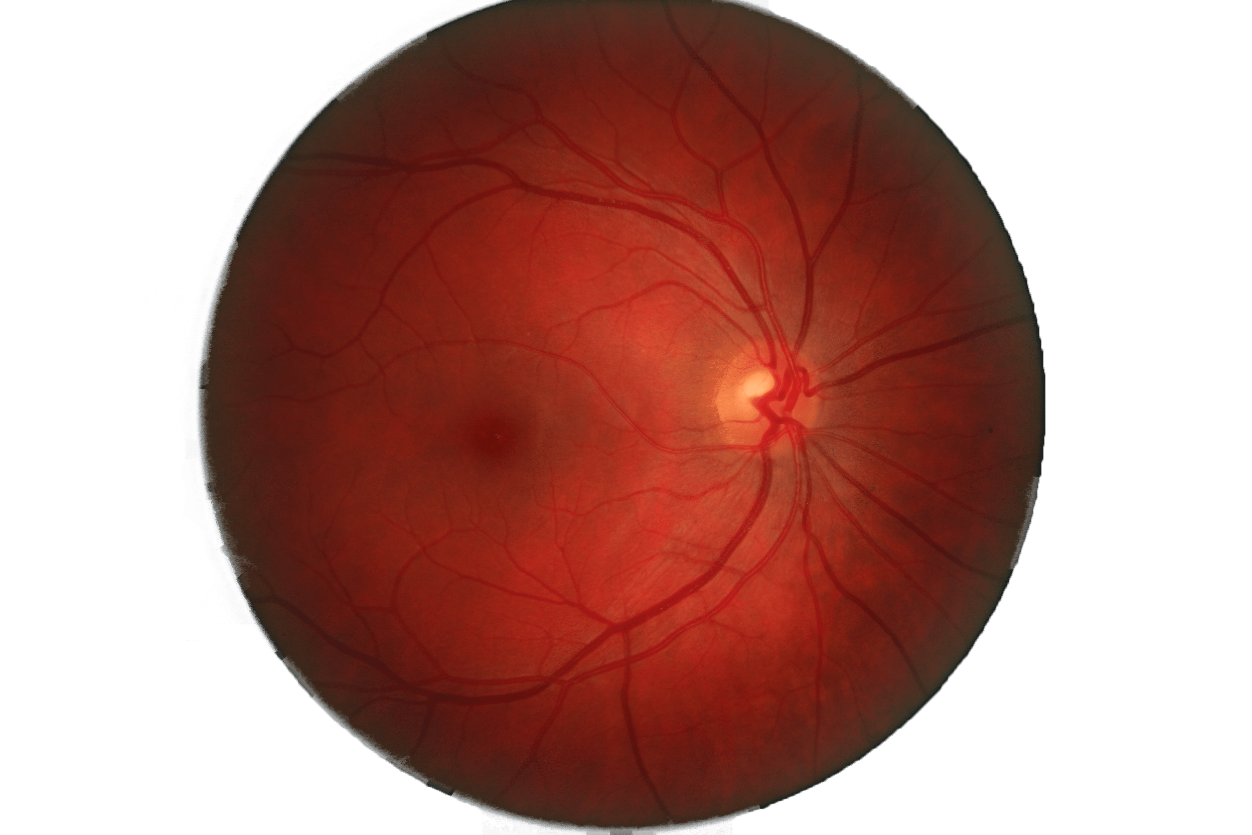 retina retinopatii