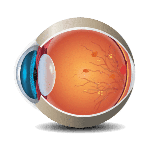 retinopatie diabetica proliferativa
