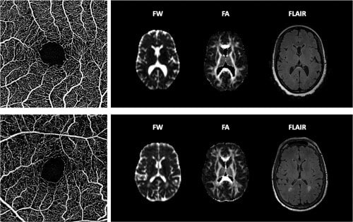 Perfuzia retiniană este legată de cogniție și biomarkerii RMN cerebrali