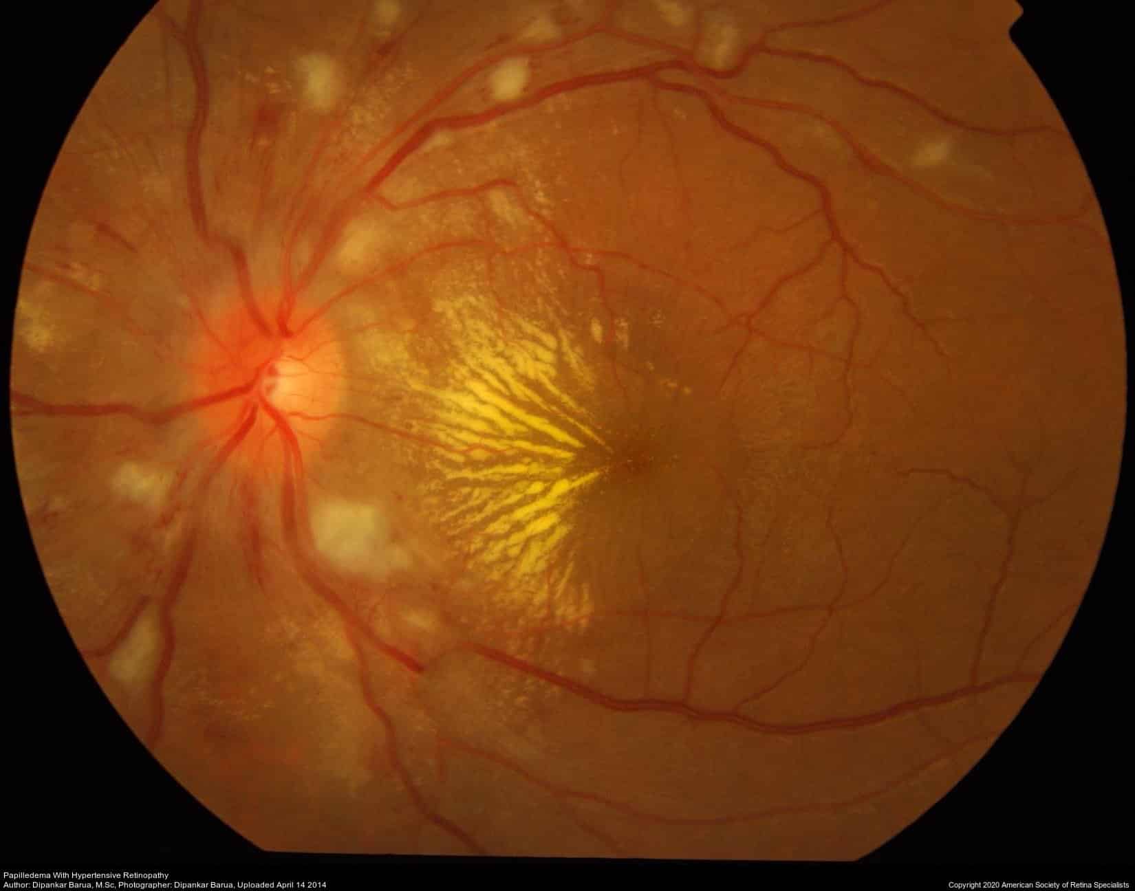 Hypertensive Retinopathy