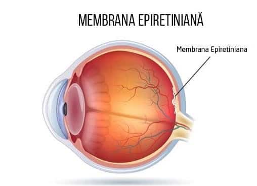 membrana epiretiniana